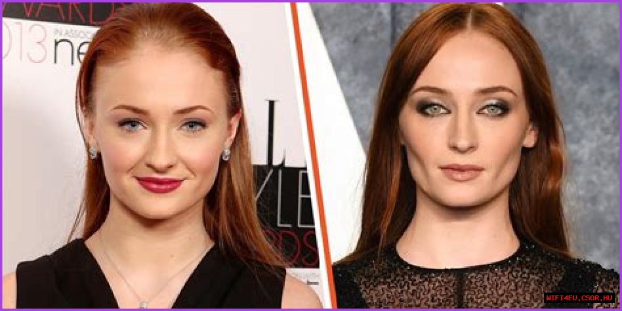 Unveiling The Transformation: Sophie Turner And Buccal Fat Removal
